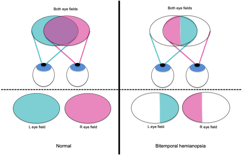 Retinal Hemifield Slide Phenomenon - EyeWiki