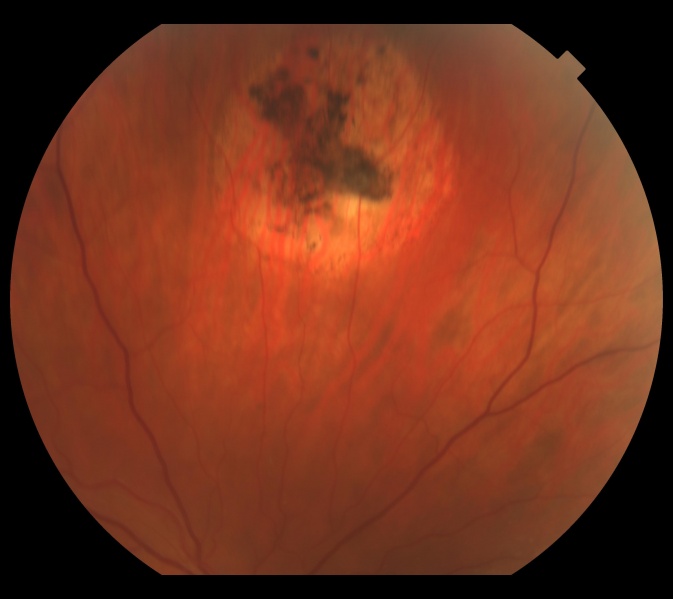 File:Treated RCH.jpg