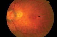 Color photo of macular hole