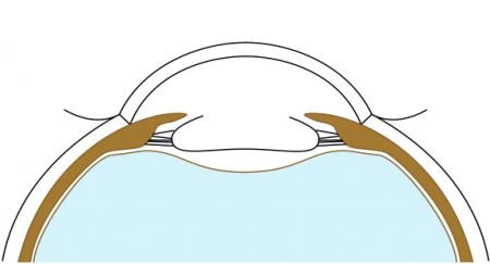 Cataract Surgery with Bag-In-the-Lens (BIL) fixation technique - EyeWiki