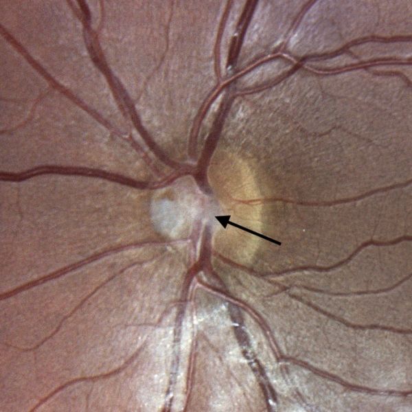 File:Bergmeister papilla fundus photo.jpg