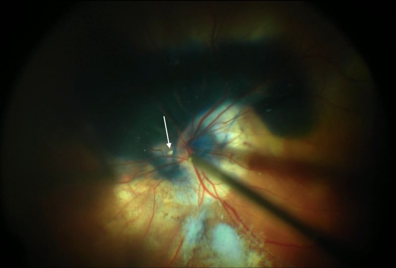 File:Intra-operative photo.jpg