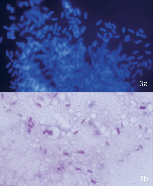File:Microsporidial Keratoconjunctivitis-scrapings.png