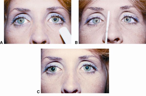 Light-Near Dissociation - EyeWiki