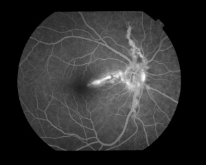 AngioidStreak OD FA236.jpg