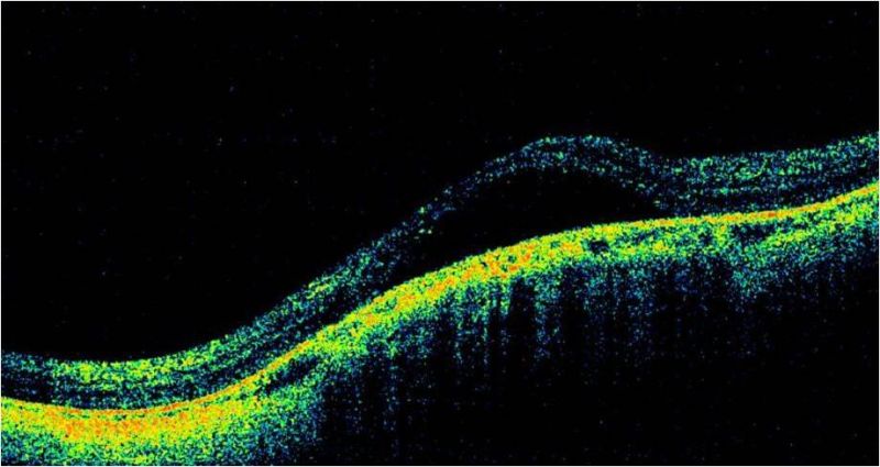 File:Dome shaped maculopathy.jpg