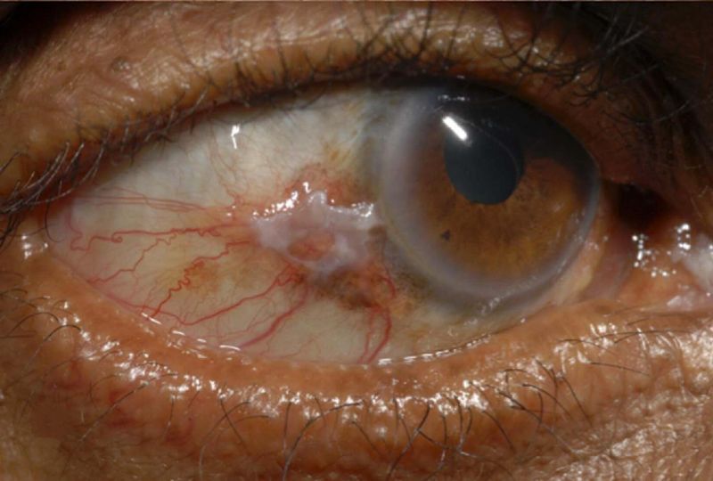 File:Conjunctival squamous cell carcinoma-01.jpg