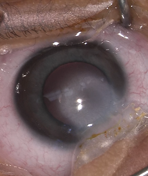 File:Peters Corneal Opacity.png