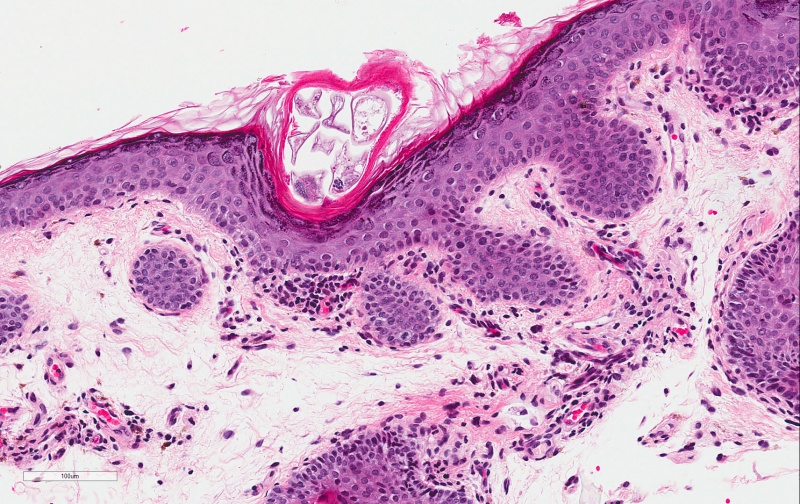 File:Demodex Folliculitis H&E 20x B-2-.jpg