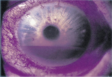 Ocular Trauma: Acute Evaluation, Cataract, Glaucoma - EyeWiki