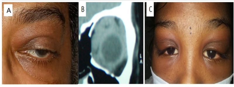 File:Inflammatory edema.jpg