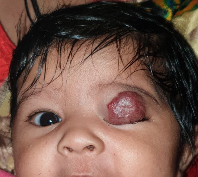 File:Upper lid hemangioma.jpg