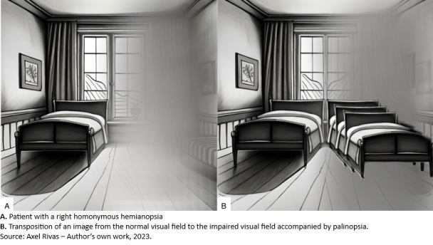 Visual Allesthesia - EyeWiki