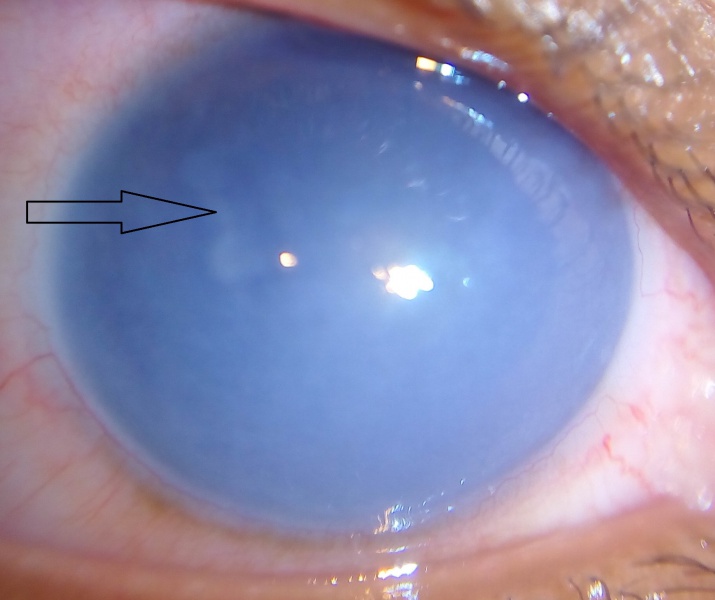 File:Bullous keratopathy with CHED.jpg