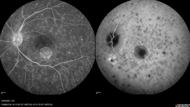 File:Macular I CNV 2.jpg