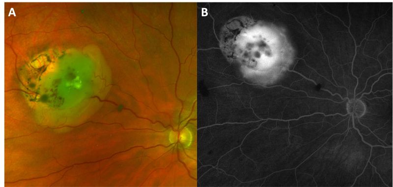 File:Retinocytoma malignant transformation.jpg