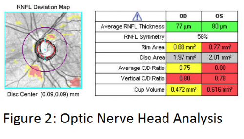Spectral Domain Optical Coherence Tomography in Glaucoma - EyeWiki