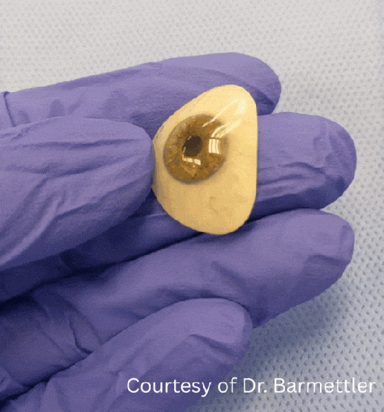 File:Ocular Prosthesis.gif