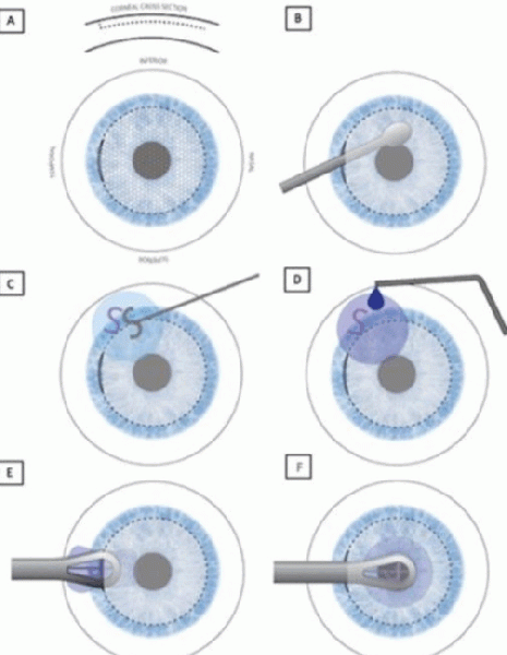 File:SLIKE Procedure Steps.gif