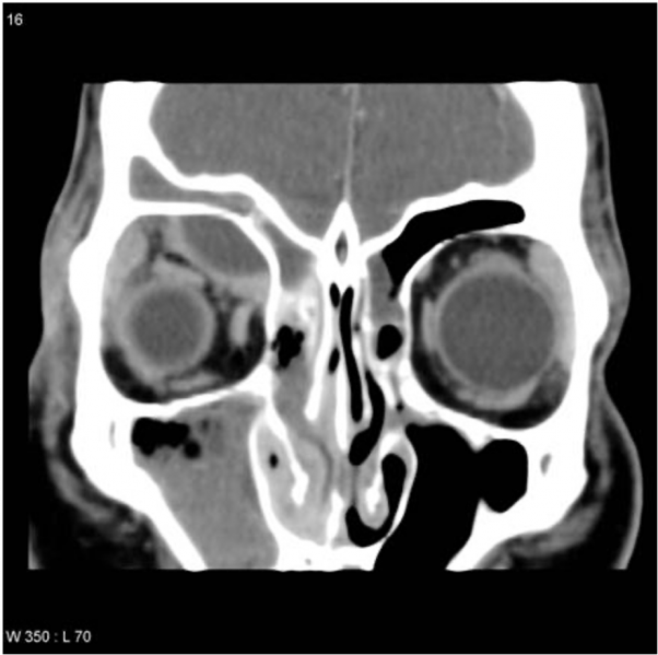 File:Sub periosteal abscess.png