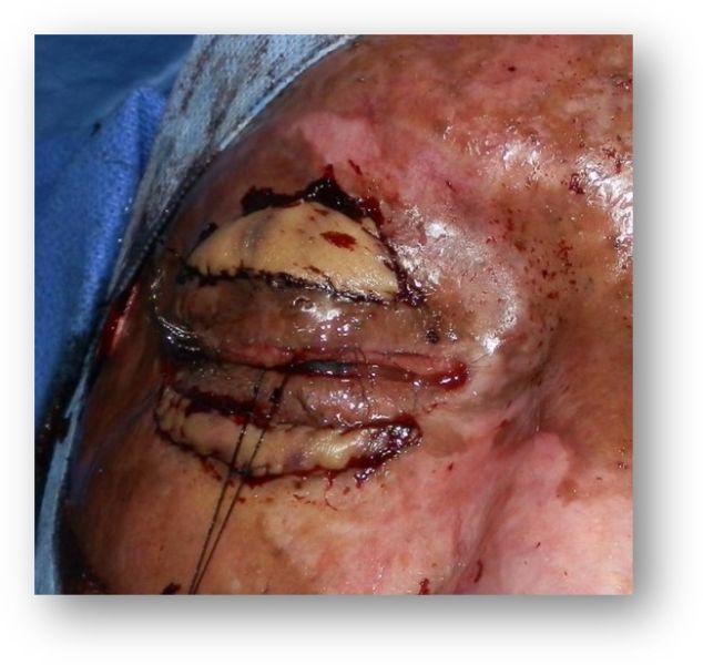 File:FT skin graft.jpg