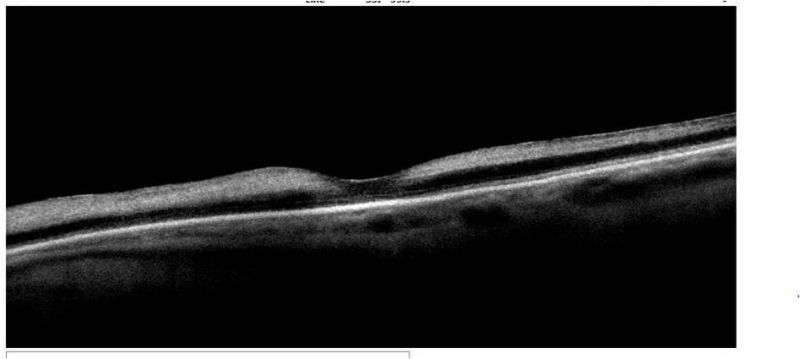 File:Inner retinal hyperreflectivity CRAO.jpg