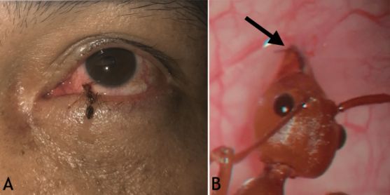 Animal-Induced Ocular Trauma - EyeWiki