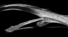 Longitudinal UBM inferior quadrant probe oriented toward limbus.jpg