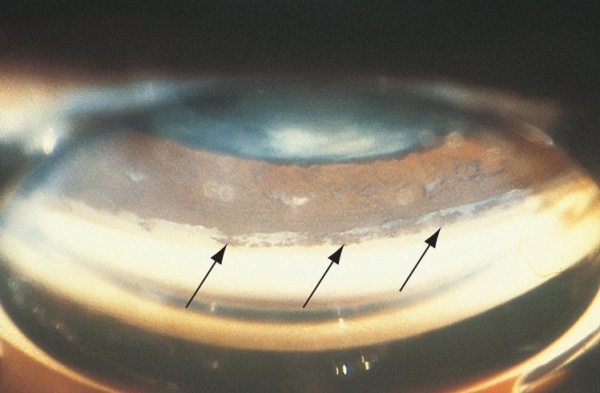 Ocular Trauma: Acute Evaluation, Cataract, Glaucoma - EyeWiki