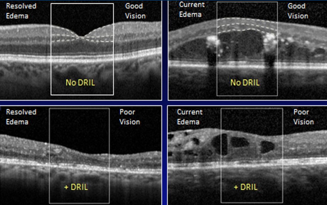 Diabetic Macular Edema - EyeWiki