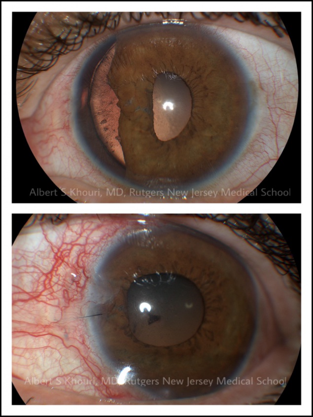 Traumatic Glaucoma - EyeWiki