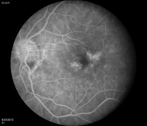 Late phase of the left eye