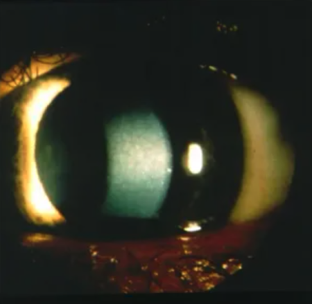 central-cloudy-dystrophy-of-fran-ois-eyewiki