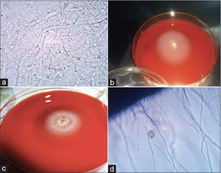 File:Figure 4 Eyewiki.png