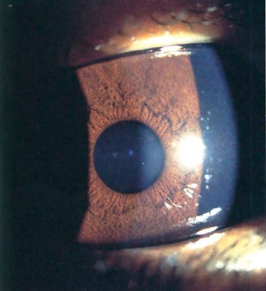 File:Iris Nodular nevi-2.jpg
