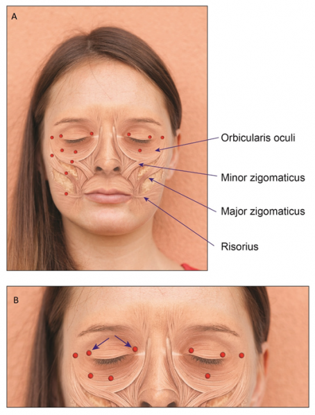 File:Botulinum injection sites.png