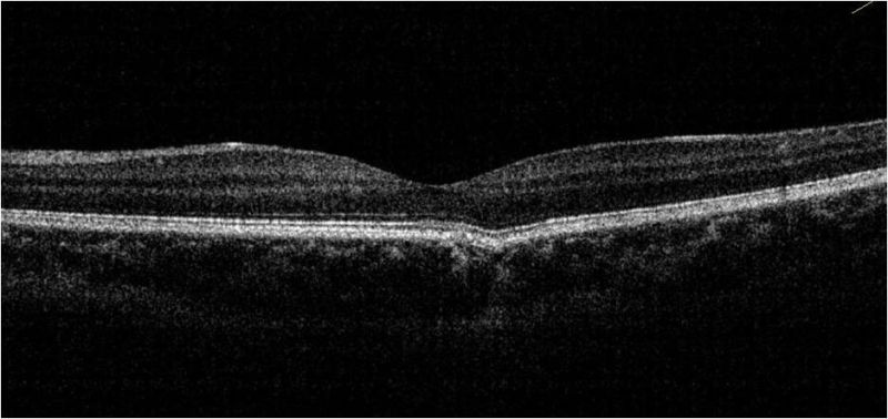 File:Focal choroidal excavation.jpg