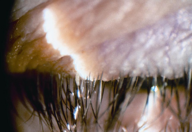 File:Demodectric blepharitis.jpg