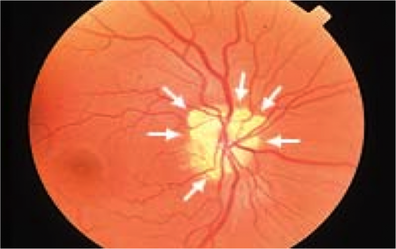 File:Fundus ODD.png