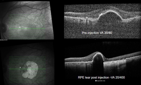 Retinal Pigment Epithelial Tears - EyeWiki