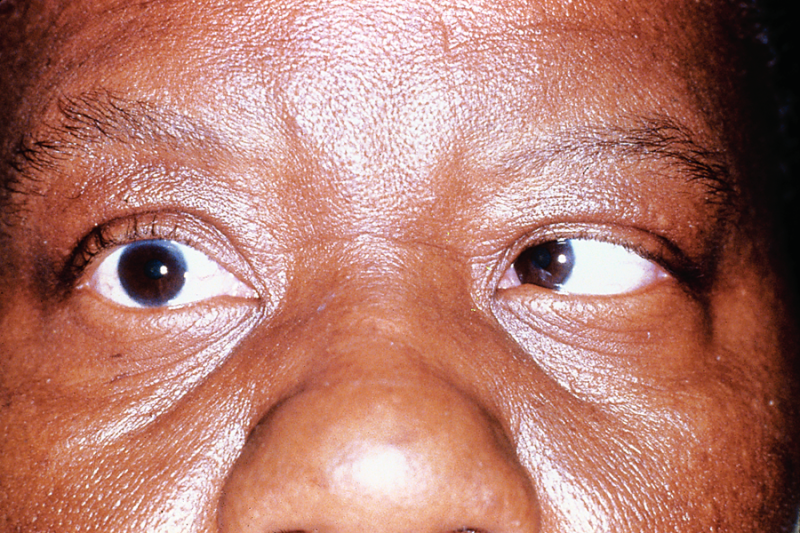 File:Sixth neve palsy.png