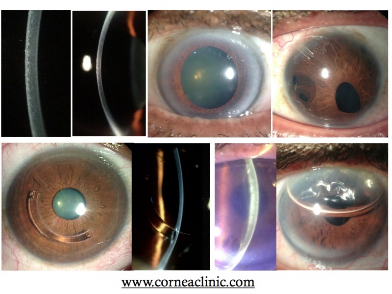 File:Fogla Slit Lamp Pics.jpg