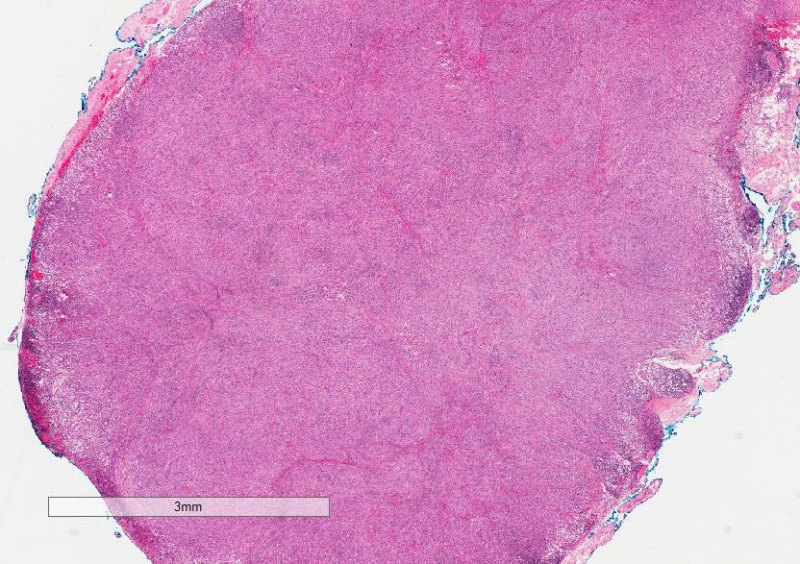 File:Fibrous Histiocytoma H&E 1.0x.jpg