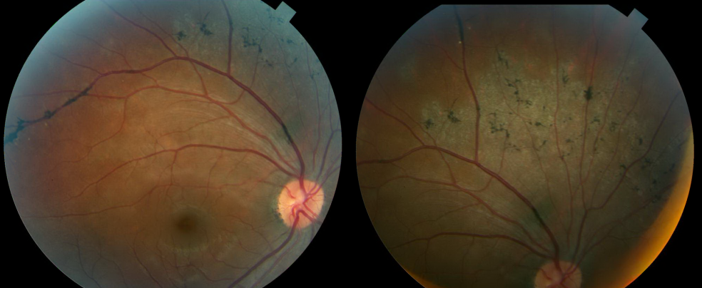 Pigmented Paravenous Retinochoroidal Atrophy - EyeWiki