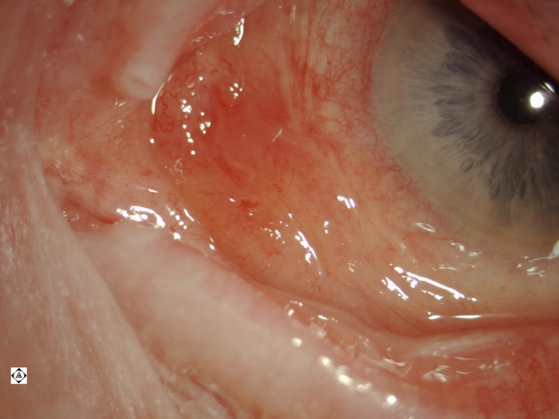 File:Conjunctival Amyloidosis.jpg