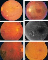 Figure 1. Color fundus photograph of the left eye in case 1 in 1995 showing lipid exudates (arrow), cotton wool spots, and intraretinal hemorrhages of diabetic retinopathy as well as multiple refractile intraretinal crystals (arrowhead). Figure 2. Color fundus photograph of the left eye in case 1 in 2001 after focal photocoagulation for diabetic macular edema. The edema has completely resolved, and there are fewer intraretinal crystals, which are arranged in a pattern different from that in 1995. Figure 3. Color fundus photograph of the right eye in case 2 showing a frond of retinal neovascularization and many iridescent intraretinal crystals within the foveal avascular zone. Figure 4. Mid-phase fluorescein angiogram of the right eye in case 2 showing the perfused retinal neovascularization and the absence of any fluorescein angiographic sign of the crystals. Figure 5. Color fundus photograph of the right eye in case 2 one year after panretinal laser photocoagulation. Most of the crystals have resolved. Figure 6. Color fundus photograph of the right eye in case 3. The distribution of the intraretinal crystals follows the pattern of the distribution of intraretinal lipid from diabetic macular edema. The diabetic lipid exudates (arrow) can be distinguished from the refractile crystals (arrowhead).