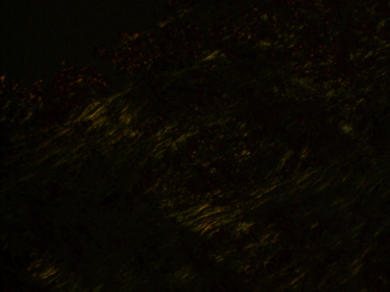 File:Amyloid Apple Green Birefringence.JPG