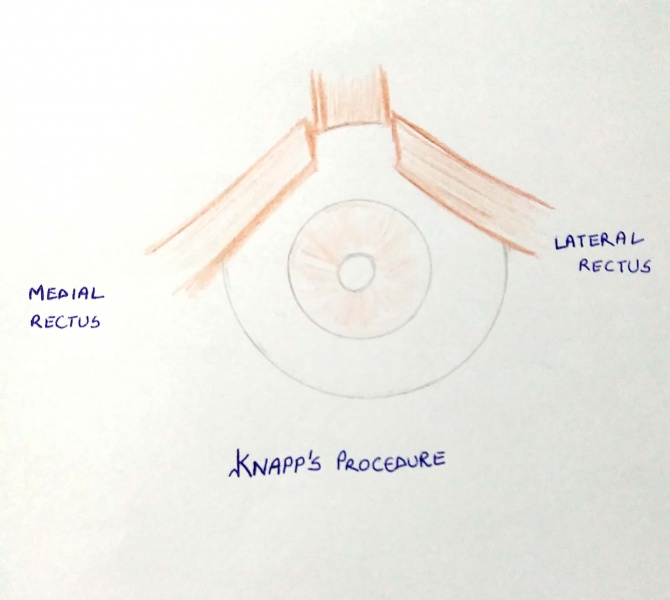 File:Knapps procedure.jpeg