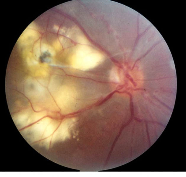 File:Macular exudation IRVAN 1978.jpg
