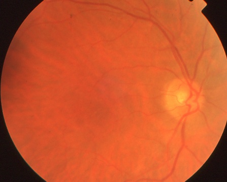 Normal right fundus of the same CAR patient with visual field defects.